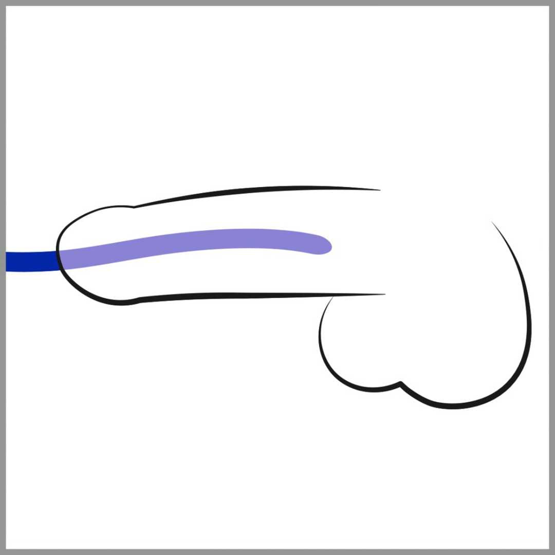 3-teiliges Dilatorenset