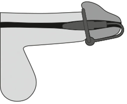 Penisplug - Urethral Plug - Dilator